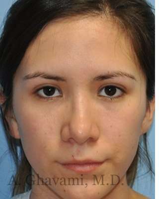 Revision Rhinoplasty Before & After Patient #7033