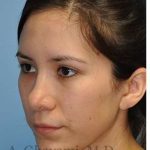 Revision Rhinoplasty Before & After Patient #7033