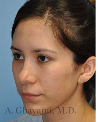 Revision Rhinoplasty Before & After Patient #7033