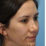 Revision Rhinoplasty Before & After Patient #7033