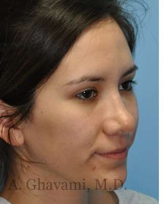 Revision Rhinoplasty Before & After Patient #7033