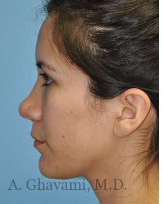 Revision Rhinoplasty Before & After Patient #7033