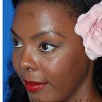 Ethnic Rhinoplasty Before & After Patient #7024