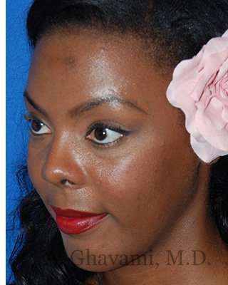 Ethnic Rhinoplasty Before & After Patient #7024