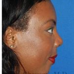 Ethnic Rhinoplasty Before & After Patient #7024