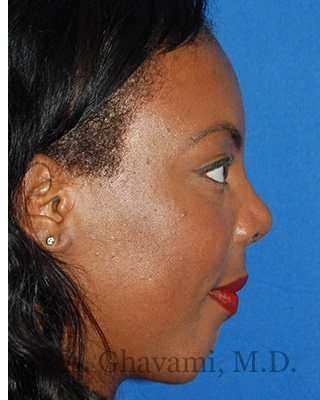 Ethnic Rhinoplasty Before & After Patient #7024