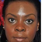 Ethnic Rhinoplasty Before & After Patient #7024