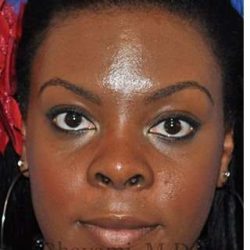 Ethnic Rhinoplasty Before & After Patient #7024