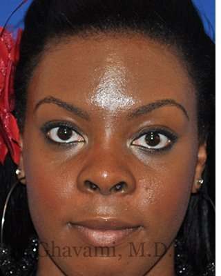 Ethnic Rhinoplasty Before & After Patient #7024