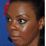 Ethnic Rhinoplasty Before & After Patient #7024