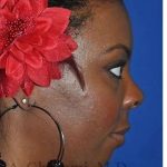 Ethnic Rhinoplasty Before & After Patient #7024