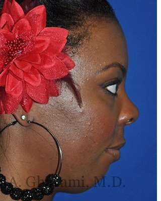 Ethnic Rhinoplasty Before & After Patient #7024