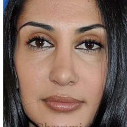 Revision Rhinoplasty Before & After Patient #7010