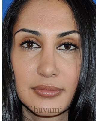 Revision Rhinoplasty Before & After Patient #7010
