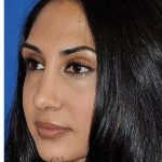 Revision Rhinoplasty Before & After Patient #7010
