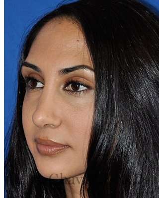 Revision Rhinoplasty Before & After Patient #7010