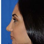 Revision Rhinoplasty Before & After Patient #7010