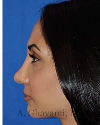 Revision Rhinoplasty Before & After Patient #7010