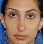 Revision Rhinoplasty Before & After Patient #7010