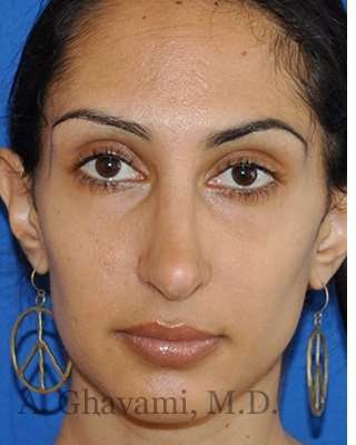Revision Rhinoplasty Before & After Patient #7010