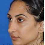 Revision Rhinoplasty Before & After Patient #7010
