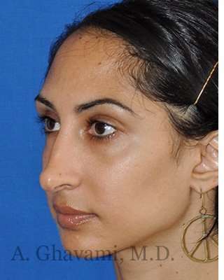 Revision Rhinoplasty Before & After Patient #7010
