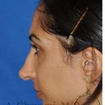 Revision Rhinoplasty Before & After Patient #7010