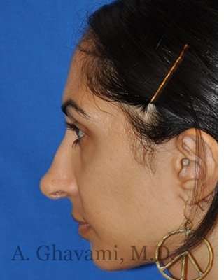 Revision Rhinoplasty Before & After Patient #7010