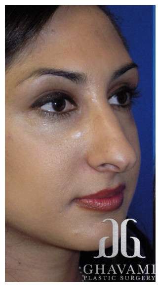 Revision Rhinoplasty Before & After Patient #7010