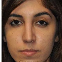 Ethnic Rhinoplasty Before & After Patient #7001