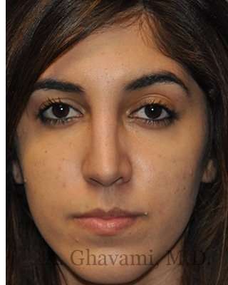 Ethnic Rhinoplasty Before & After Patient #7001