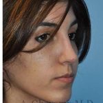 Ethnic Rhinoplasty Before & After Patient #7001