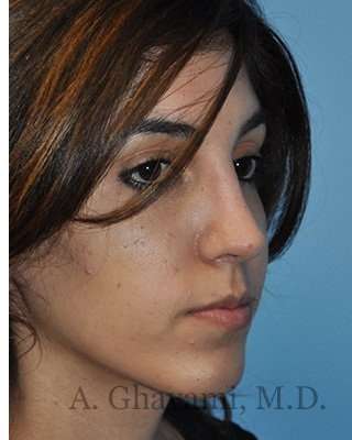 Ethnic Rhinoplasty Before & After Patient #7001