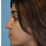 Ethnic Rhinoplasty Before & After Patient #7001