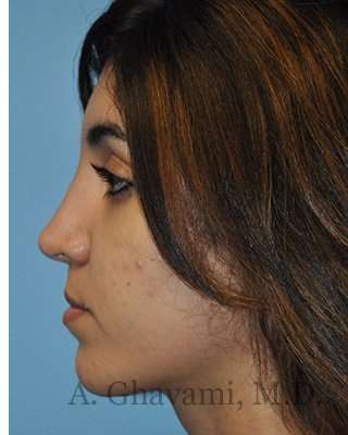 Ethnic Rhinoplasty Before & After Patient #7001