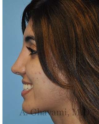 Ethnic Rhinoplasty Before & After Patient #7001