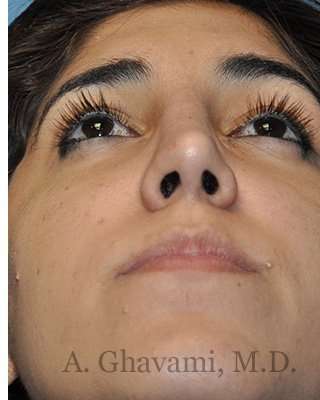 Ethnic Rhinoplasty Before & After Patient #7001