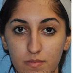 Ethnic Rhinoplasty Before & After Patient #7001
