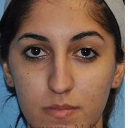 Ethnic Rhinoplasty Before & After Patient #7001
