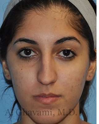 Ethnic Rhinoplasty Before & After Patient #7001