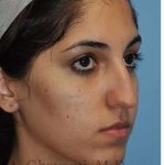 Ethnic Rhinoplasty Before & After Patient #7001