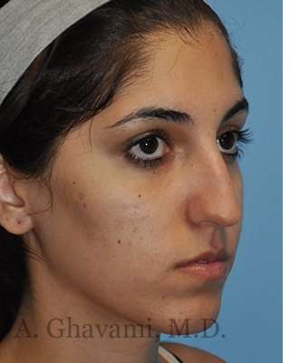 Ethnic Rhinoplasty Before & After Patient #7001