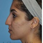 Ethnic Rhinoplasty Before & After Patient #7001