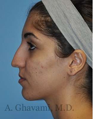 Ethnic Rhinoplasty Before & After Patient #7001