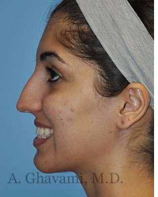 Ethnic Rhinoplasty Before & After Patient #7001