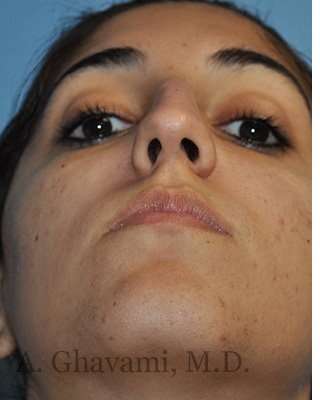 Ethnic Rhinoplasty Before & After Patient #7001