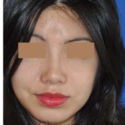 Ethnic Rhinoplasty Before & After Patient #6979