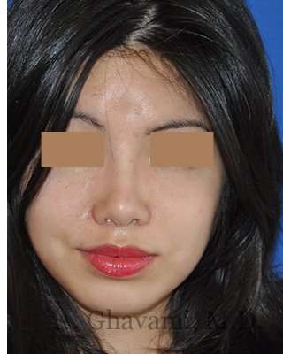 Ethnic Rhinoplasty Before & After Patient #6979