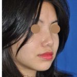 Ethnic Rhinoplasty Before & After Patient #6979