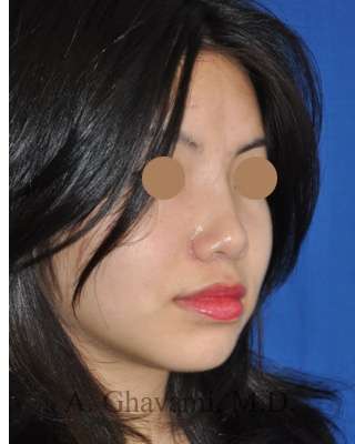 Ethnic Rhinoplasty Before & After Patient #6979